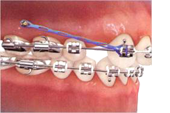 Les mini-vis en orthodontie